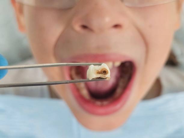 Best Emergency Wisdom Tooth Extraction in Stromsburg, NE